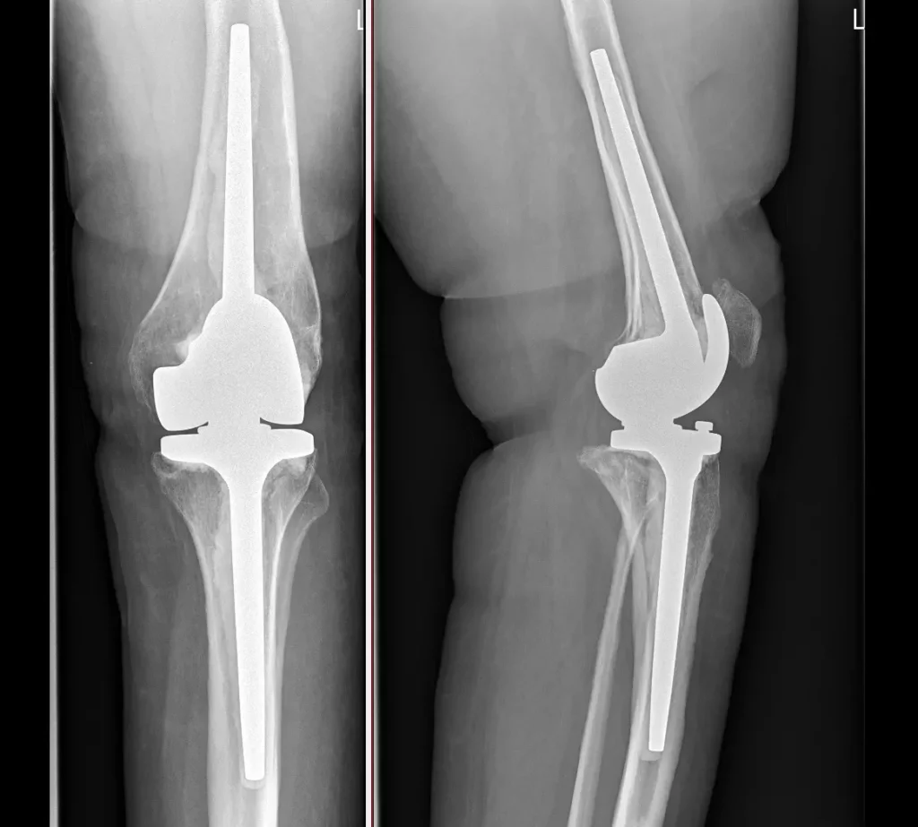 RTG závěsné endoprotézy kolenního kloubu